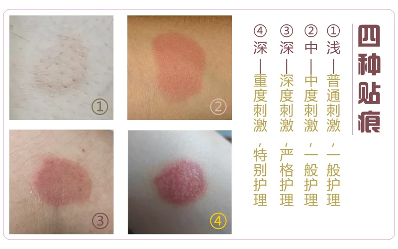 三伏贴使用方法