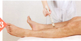 不育症的艾灸疗法