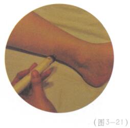 祛除雀斑的艾灸疗法