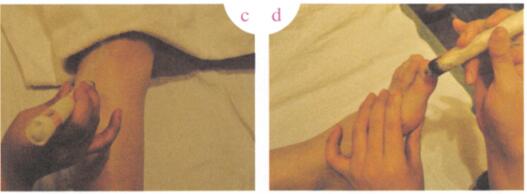 白带病的艾灸疗法