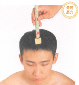 头痛的艾灸疗法