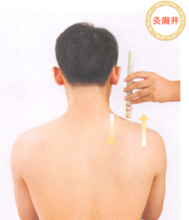 颈椎病的艾灸疗法