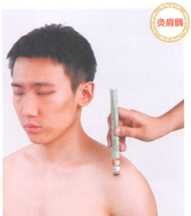 肩周炎的艾灸疗法
