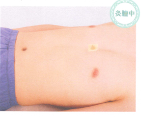 哮喘的艾灸疗法