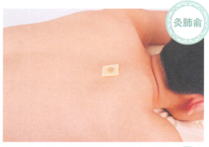 哮喘的艾灸疗法