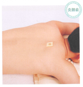 哮喘的艾灸疗法