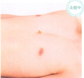 冠心病的艾灸疗法