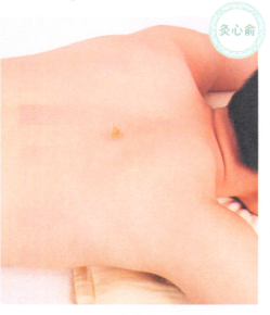 冠心病的艾灸疗法