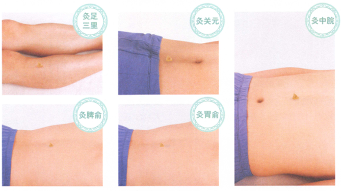 胃下垂的艾灸疗法