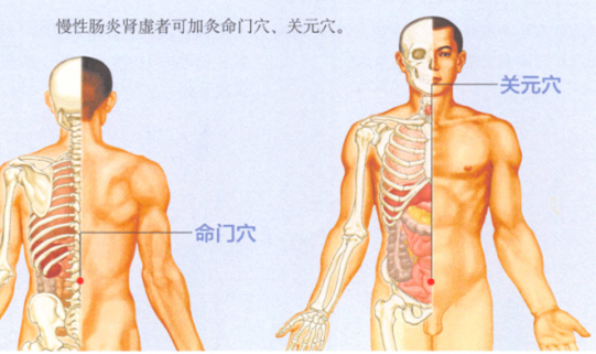 慢性肠炎的艾灸疗法