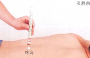 糖尿病的艾灸疗法