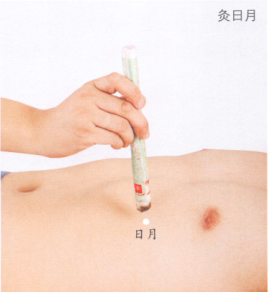胆石症的艾灸疗法