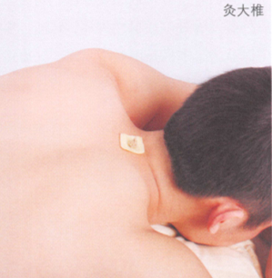 颈椎病的艾灸疗法