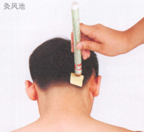 眩晕的艾灸疗法