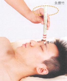 假性近视的艾灸疗法