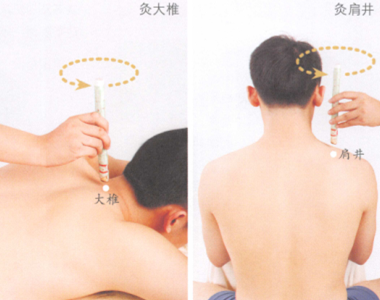 落枕的艾灸疗法