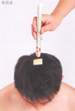 脱肛的艾灸疗法