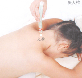 百日咳的艾灸疗法