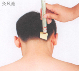 斑秃的艾灸疗法