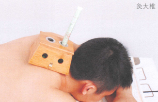 预防感冒的艾灸疗法