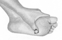 高脂血症的反射区按摩疗法