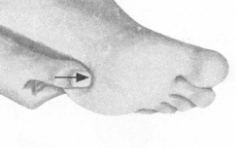 高脂血症的反射区按摩疗法