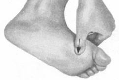 高脂血症的反射区按摩疗法