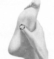 高脂血症的反射区按摩疗法