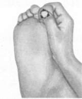 高脂血症的反射区按摩疗法