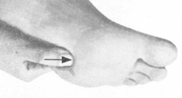 风湿病的反射区按摩疗法
