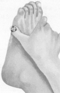 风湿病的反射区按摩疗法