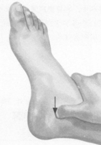 风湿病的反射区按摩疗法