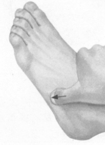 风湿病的反射区按摩疗法