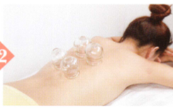 胃痉挛的拔罐疗法