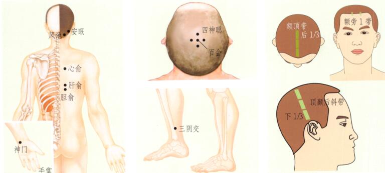失眠的刮痧疗法