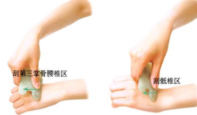 腰椎间盘突出的刮痧疗法