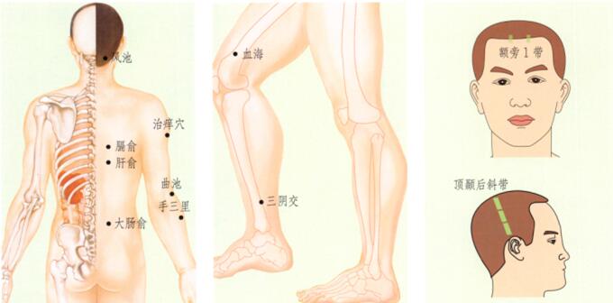 荨麻疹的刮痧疗法
