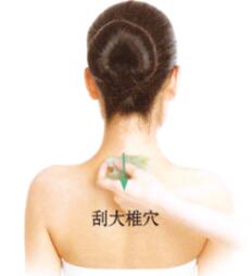 扁平疣的刮痧疗法