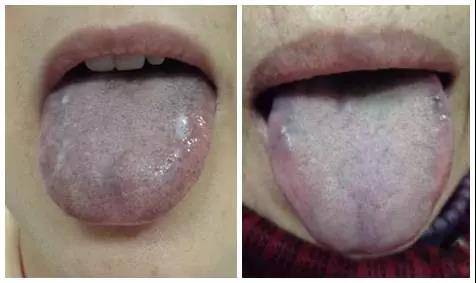 血瘀体质的日常调理