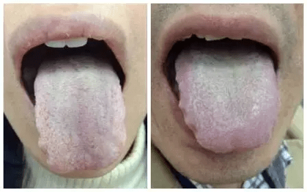 痰湿体质的日常调理