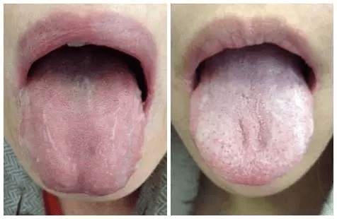 气郁体质的日常调理