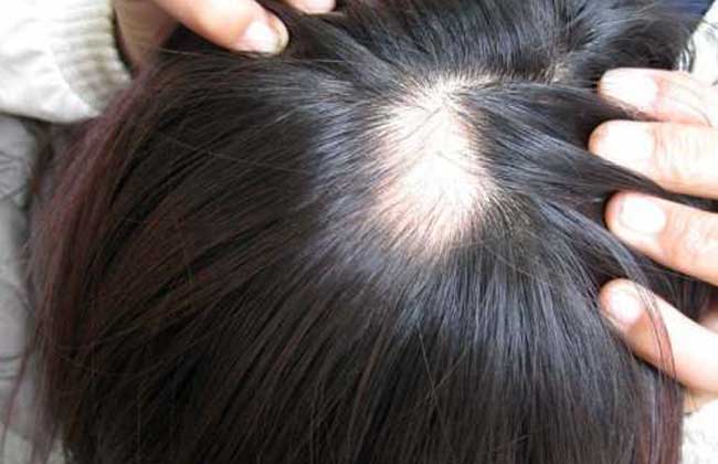 斑秃治疗最快的方法