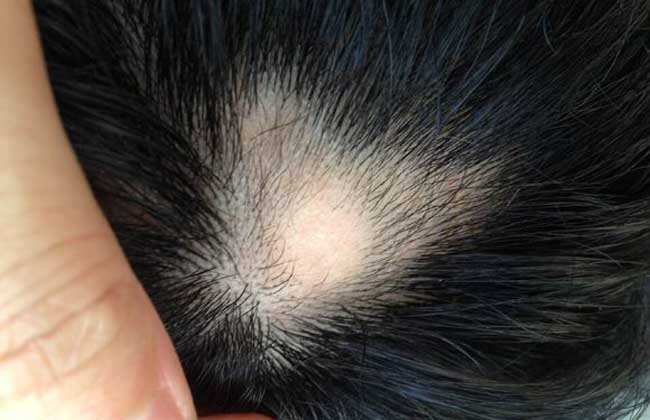 斑秃治疗最快的方法