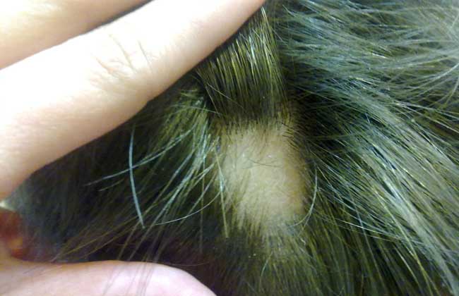 斑秃治疗最快的方法