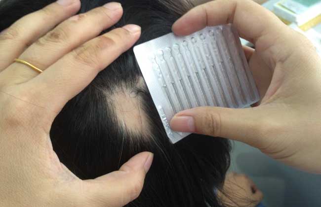 斑秃治疗最快的方法