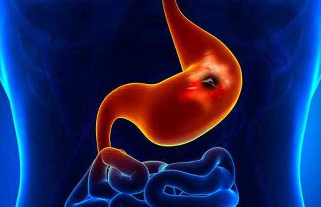 幽门螺旋杆菌的症状和治疗