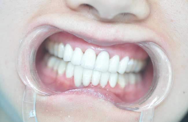 种植牙的寿命多少年？