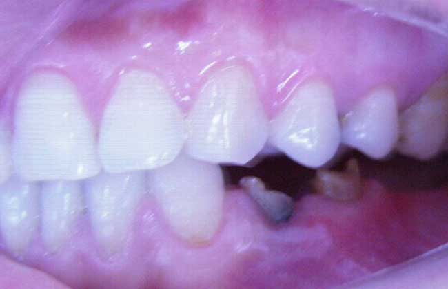 种植牙的寿命多少年？