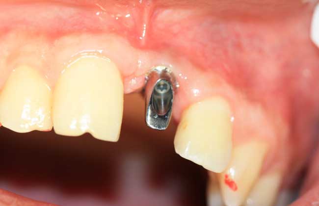 种植牙齿的危害与好处