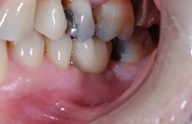 种植牙齿的危害与好处